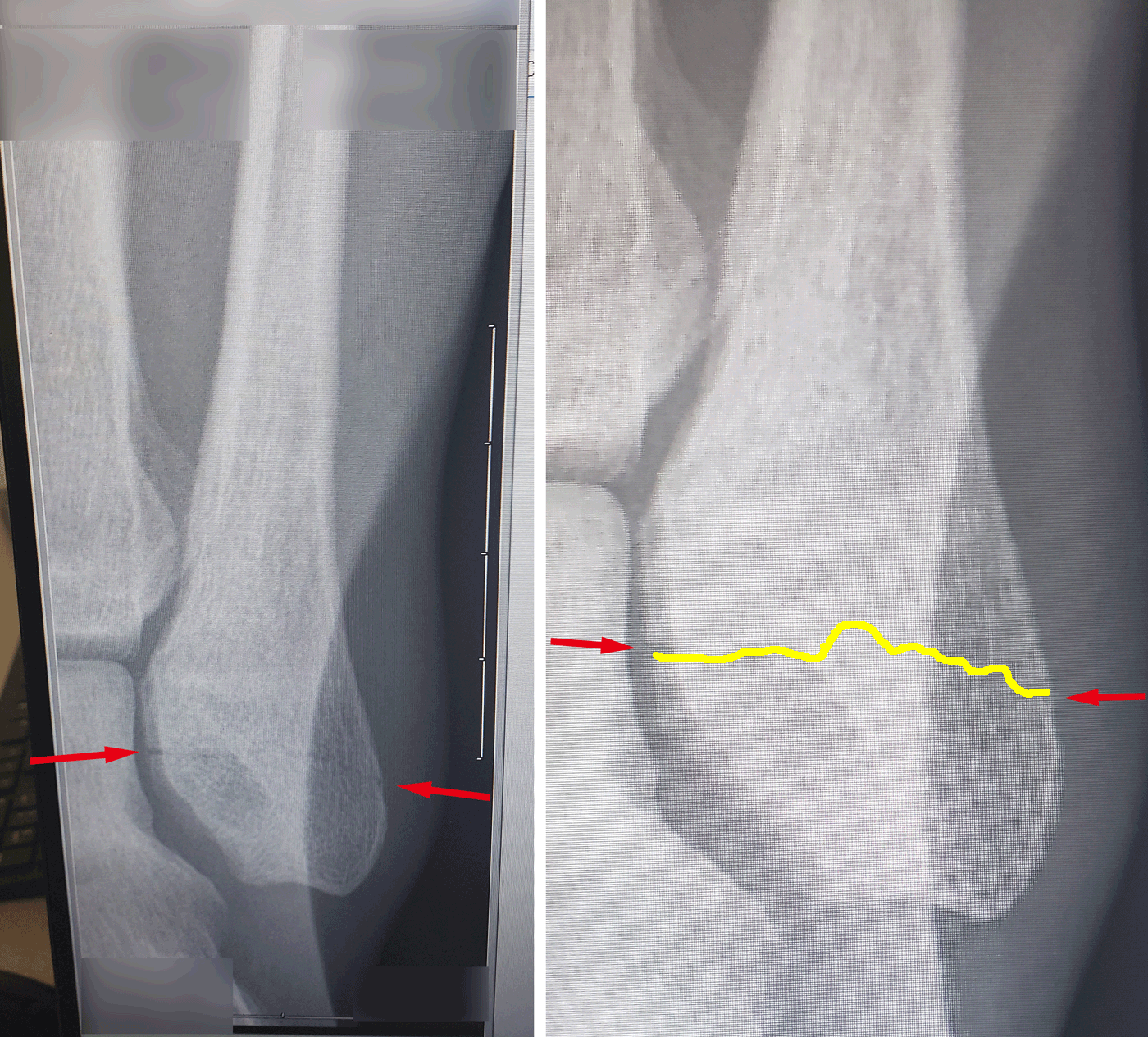 Fibula-fracture-animated-2.gif